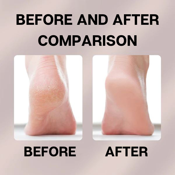BeautyFeet©️ - Electric Callus and Cracked Heel Remover